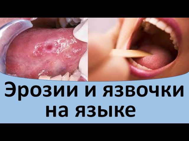 Симптомы язвенной болезни: как распознать заболевание